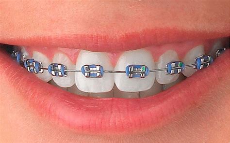 brackets metalicos precio peru|precio de los brackets dentales.